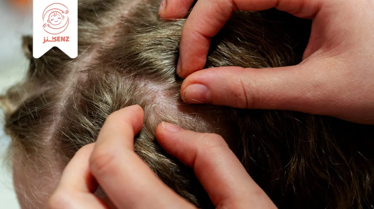 القمل عند الأطفال