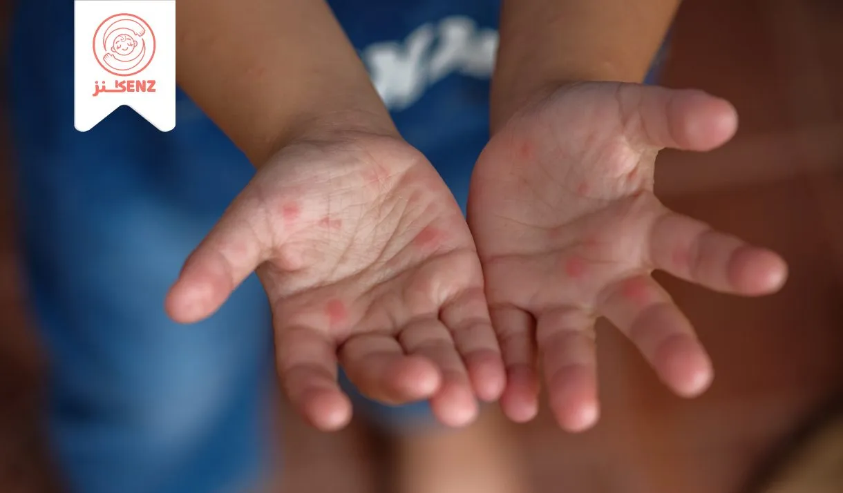 مرض فم يد قدم