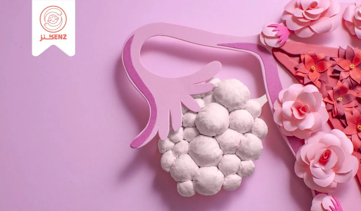 متلازمة المبيض المتعدد الكيسات